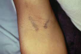 bruising on the inside of the elbow lining two major veins used for injection - heroin track mark